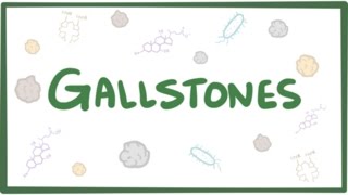 Gallstones cholelithiasis [upl. by Telracs989]