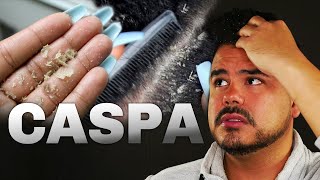 ⚠️ 7 RECOMENDACIONES y CAUSAS de LA CASPA  Médico Estético explica QUÉ ES LA CASPA  DR SAUCILLO [upl. by Ayokahs804]