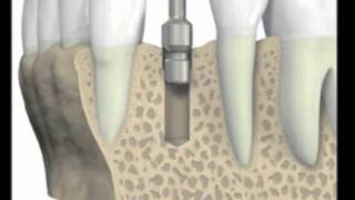 Dental Implant Placement Procedure [upl. by Nylatsyrc512]