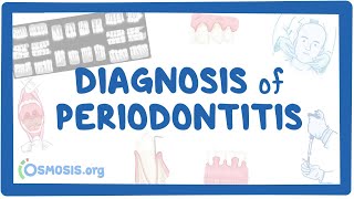 Diagnosis of Periodontitis [upl. by Eedissac]