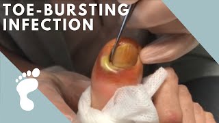 OOZING PUS  INFECTED INGROWN [upl. by Aicilev]