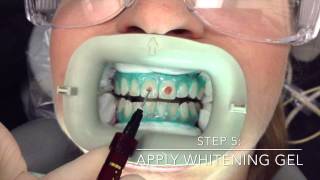 Professional InOffice Teeth Whitening by Mint Dental OC in Yorba Linda Orange County [upl. by Yort898]