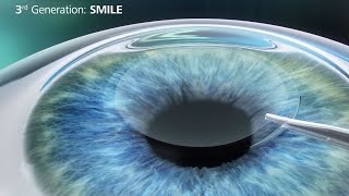 My LASIK Eye Surgery Experience [upl. by Izawa]