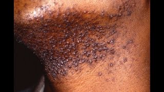 PSEUDOFOLLICULITIS BARBAE Razor Bumps Symptoms Causes Treatment [upl. by Archer]