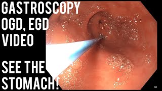 Gastroscopy  OGD  See inside the stomach [upl. by Luther536]