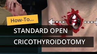 Standard Open Cricothyroidotomy [upl. by Oleta]