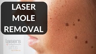 LASER MOLE REMOVAL [upl. by Inalem977]