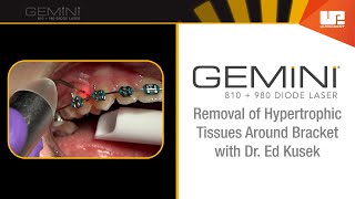 Hypertrophic Tissue Removal  How To Use the Gemini™ Laser [upl. by Nyllewell947]