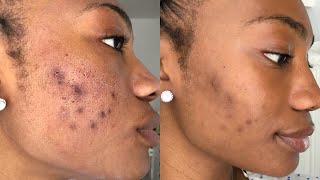 CLEARING UP ACNE SCARRING amp HYPERPIGMENTATION [upl. by Lleret489]