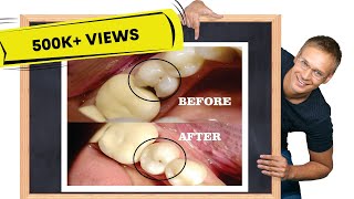 Class II cavity restoration  STEPBYSTEP [upl. by Annabel]