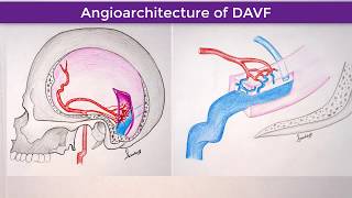 Right TransverseSigmoid Sinus Dural Arteriovenous Fistula [upl. by Tankoos415]