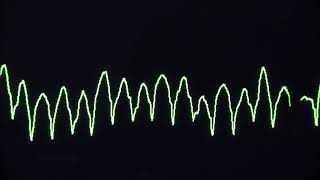 Cardiac arrest rhythms VF VT Asystole and PEA [upl. by Ynffit]