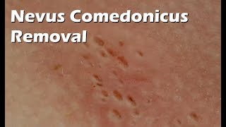 Nevus Comedonicus Removal  9 minutes worth [upl. by Ilowell461]