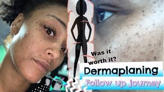 Skin Scraping follow up Dermaplaning Facial [upl. by Yseulta]