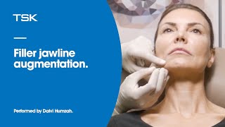 Filler jawline augmentation using cannula [upl. by Lorri]