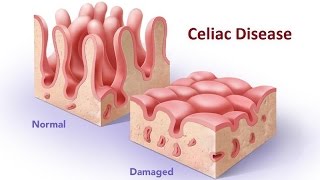 Celiac Disease [upl. by Sihunn]