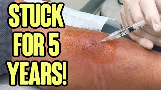 Leg Double Feature  Infected Leg and Amazing Toothpick Splinter Removal [upl. by Enttirb]