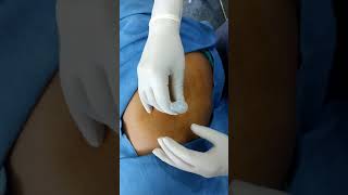 Trochanteric Bursitis Injection Depomedrol [upl. by Gehman]