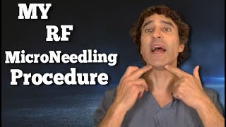 MY RF Microneedling RESULTS and EXPECTATIONS  Dr Rajani [upl. by Oralle]