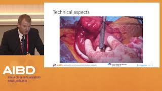 Lecture 83 Intestinal Resection and Anastomosis [upl. by Enomas]