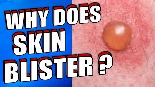 Why Does Skin Blister  How To Treat amp Prevent Skin Blisters Naturally [upl. by Urbano]