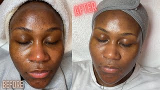 Hyperpigmentation Correction w Microdermabrasion [upl. by Aramoy]