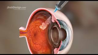 Intravitreal Injection of AntiVEGF [upl. by Ydnerb814]