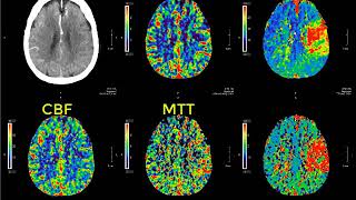 Introduction to CT perfusion before Call [upl. by Eittod28]