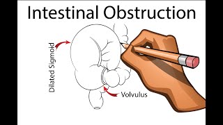 Intestinal Obstruction  Part 1 [upl. by Nicolis]