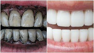 3 Way to Whiten Your Yellow Teeth Naturally [upl. by Nanreh]