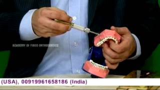 Orthodontic Mini Screw Implant TAD Placement Demonstration [upl. by Haiasi]