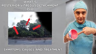 What is Posterior Vitreous Detachment PVD Symptoms Causes and Treatment [upl. by Iain]