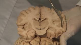 Cortical Localization Neuroanatomy Video Lab  Brain Dissections [upl. by Nihi250]