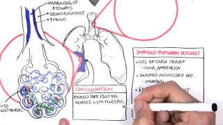 PART I  Pneumonia Overview Lobar and Bronchopneumonia [upl. by Aihsital]