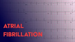 Atrial Fibrillation Afib  EKG ECG Interpretation [upl. by Ankney772]