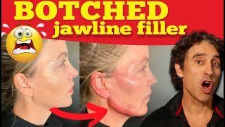 JAWLINE FILLER GONE WRONG  Botched Jawline Contouring [upl. by Nylissej]