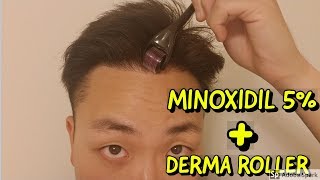 HOW TO USE DERMA ROLLER AND MINOXIDIL FOR HAIR GROWTH [upl. by Olivie956]