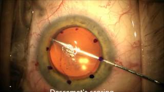 Descemet’s Membrane Endothelial Keratoplasty DMEK [upl. by Oilicec531]