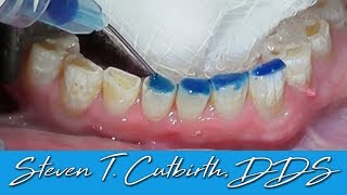 Bonding Worn Anterior Teeth  Dental Minute with Dr Steven T Cutbirth DDS [upl. by Hcir847]