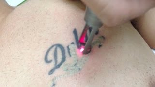 Tattoo Removal using Spectra Laser  Los Angeles Skin Perfect Brothers [upl. by Vite206]