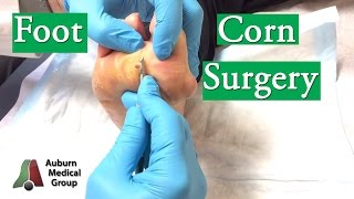 Foot Corn Surgery Treatment [upl. by Halley]