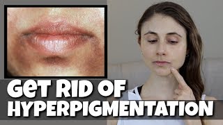 GET RID OF HYPERPIGMENTATION AROUND THE MOUTH DR DRAY [upl. by Letram]