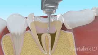 Endodoncia completa PASO A PASO  Video 3D [upl. by Egni401]