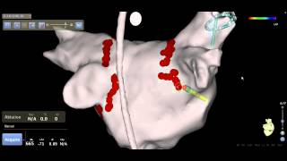 Catheter Ablation  Atrial Fibrillation Afib Treatment [upl. by Emmalyn]