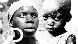 The Eradication Of Smallpox  Invisible Killers [upl. by Carena]