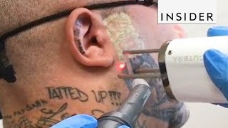 Eliminación de Tatuajes  Insider Español [upl. by Anairt]