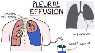 Understanding Pleural Effusions [upl. by Kalina]