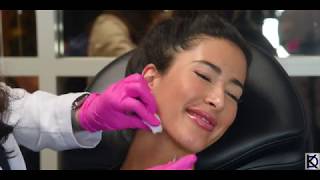 Jawline Filler Using Radiesse with KyleeCampbell [upl. by Bilac]