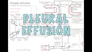 Pleural Effusion DETAILED  pathophysiology signs and symptoms treatment [upl. by Pulling503]