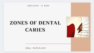 DENTAL CARIES ZONES [upl. by Symer]